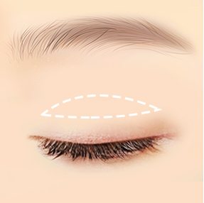 절개 02 디자인 — 쌍꺼풀 자리 점선 디자인 그림