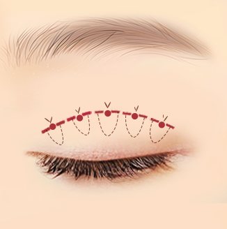 자연유착 02 미세홀 수술 — 쌍꺼풀 선 위 미세 구멍과 실 그림