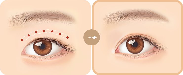 개인별 맞춤 유착 포인트 디자인 전→후 눈 그림