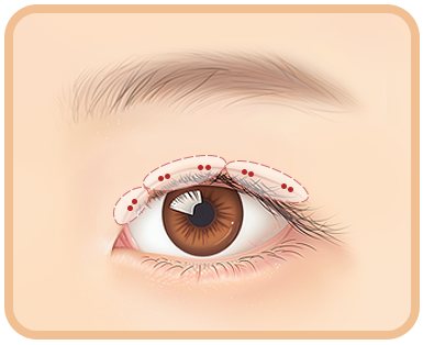 TYPE 분석을 통한 프로파일식 유착포인트